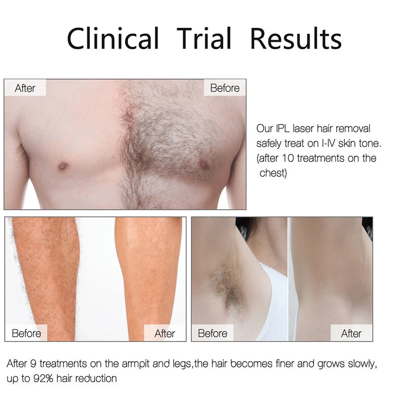 Stylique Glow™ 999,999 Flashes IPL Laser Epilator – Painless, Permanent Hair Removal for Face, Body & Bikini