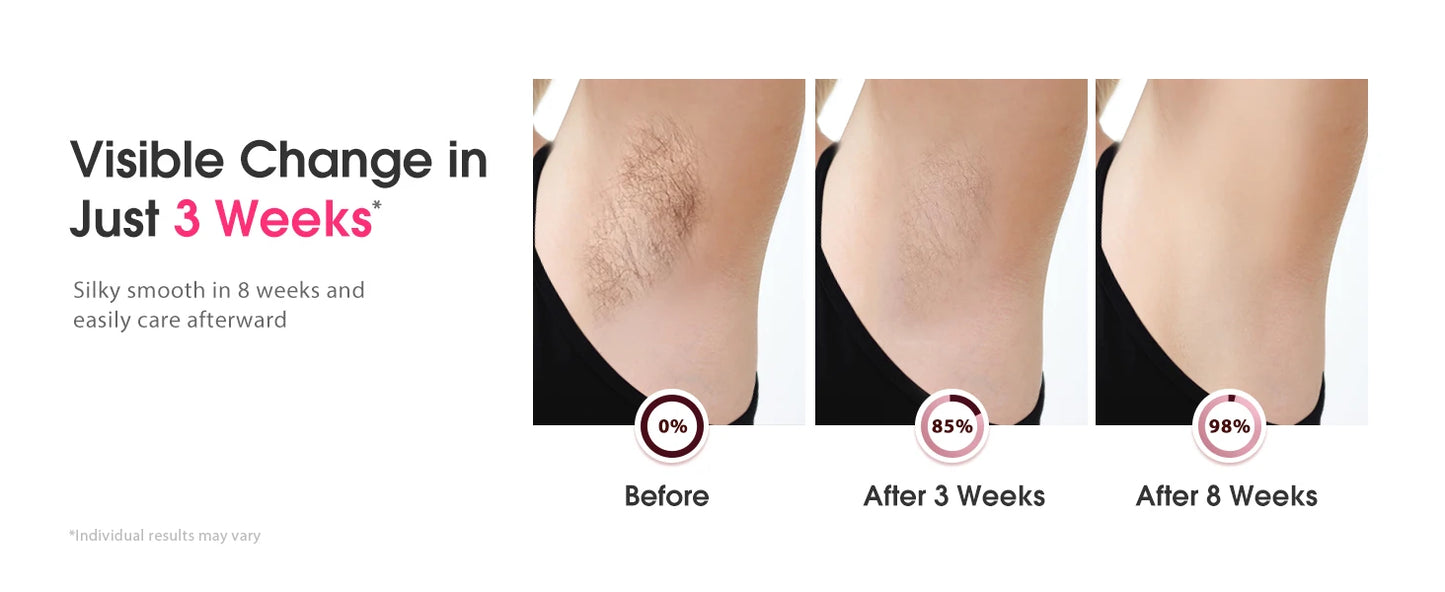 Stylique Glow IPL Laser Hair Removal – 990,000 Flashes for Smooth Skin