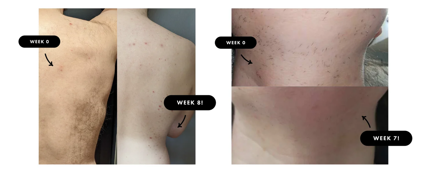 Stylique Glow 3-in-1 IPL Hair Removal Handset – Smooth Skin, Radiant Glow & Acne-Free Confidence